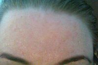 Forehead